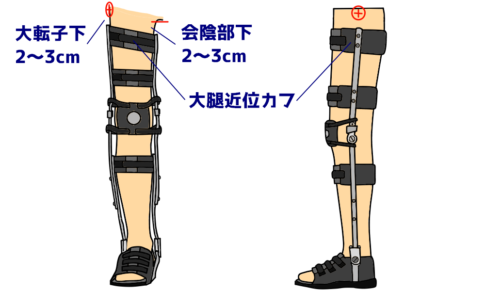 KAFO-大腿近位カフの位置設定