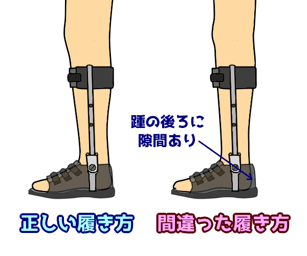 短下肢装具：両側支柱付短下肢装具ってなに？ | なぜなに。装具 まとめ