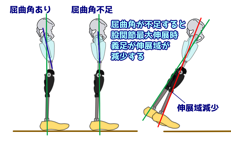 教材にどうぞ】右膝下義足