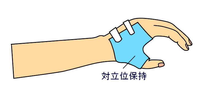 装具学 第52回作業療法士国家試験解説PM-36 上肢装具と使用の目的