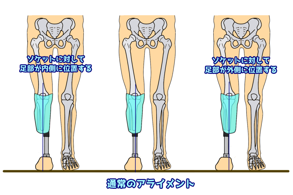 第52回理学療法士国家試験解説am 30 下腿義足のスタティックアライメント調整 なぜなに 装具 まとめ