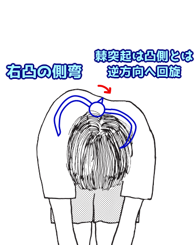 第52回理学療法士国家試験解説PM-08 側弯症装具と適応について | なぜ