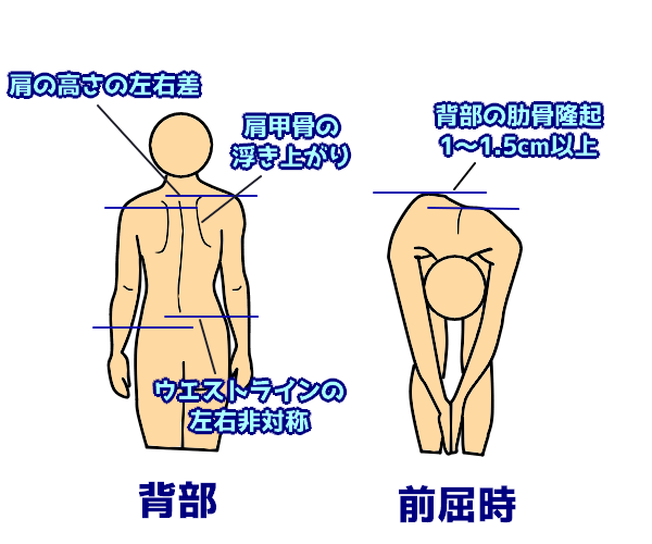 第52回理学療法士国家試験解説PM-08 側弯症装具と適応について